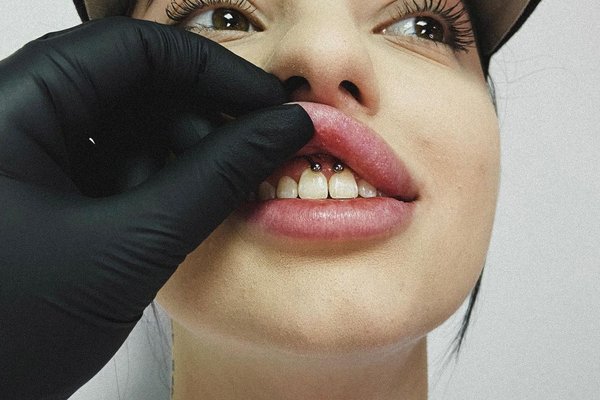 Smile пиърсинг