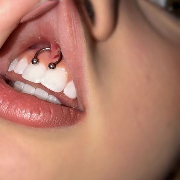 Smile пиърсинг