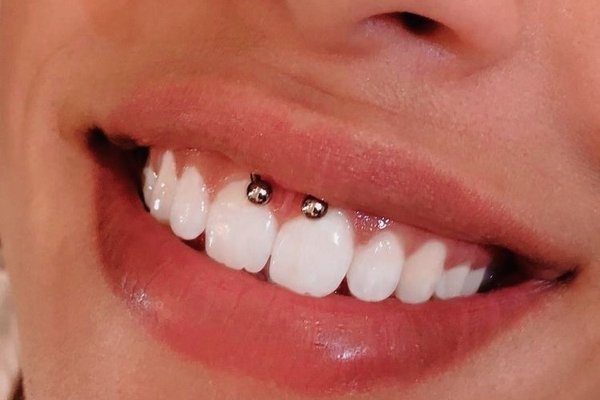 Smile пиърсинг