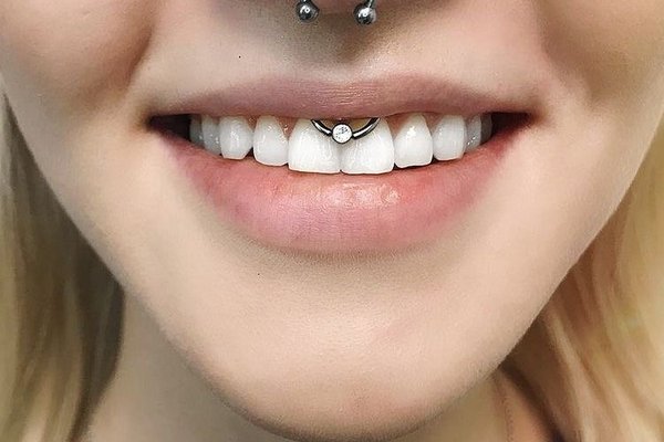 Smile пиърсинг