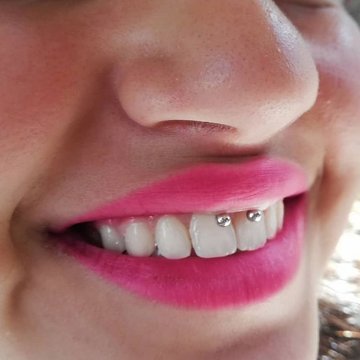 Smile пиърсинг