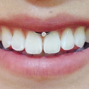 Smile пиърсинг