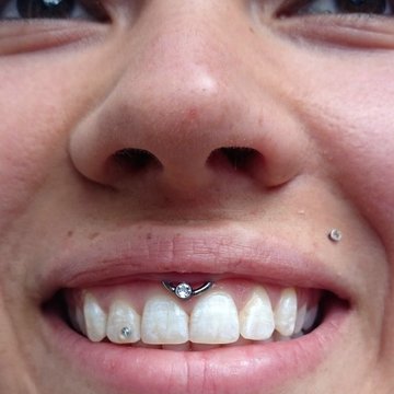 Smile пиърсинг