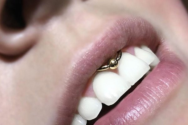 Smile пиърсинг
