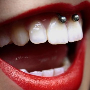 Smile пиърсинг