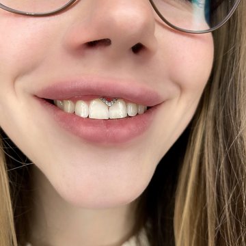 Smile пиърсинг