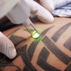 Лазерно премахване на татуировки